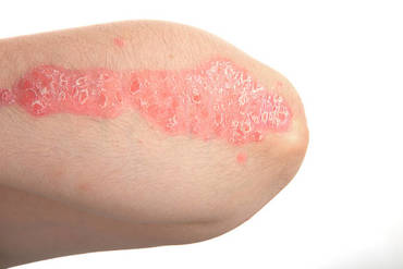 How can nutrition and diet help Psoriasis